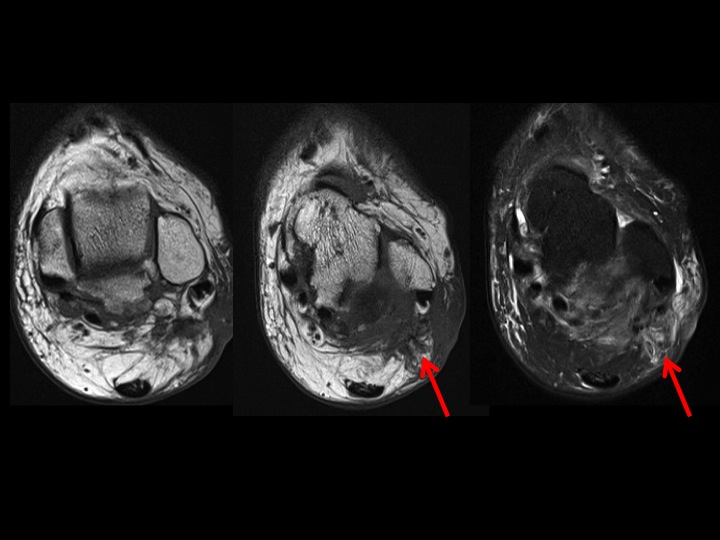 Figure 3 for case sural nerve ( RID7347 )